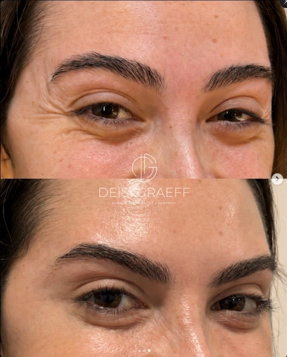 Antes e depois — olhar
