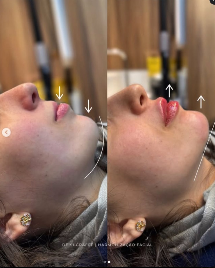 Antes e depois — perfil